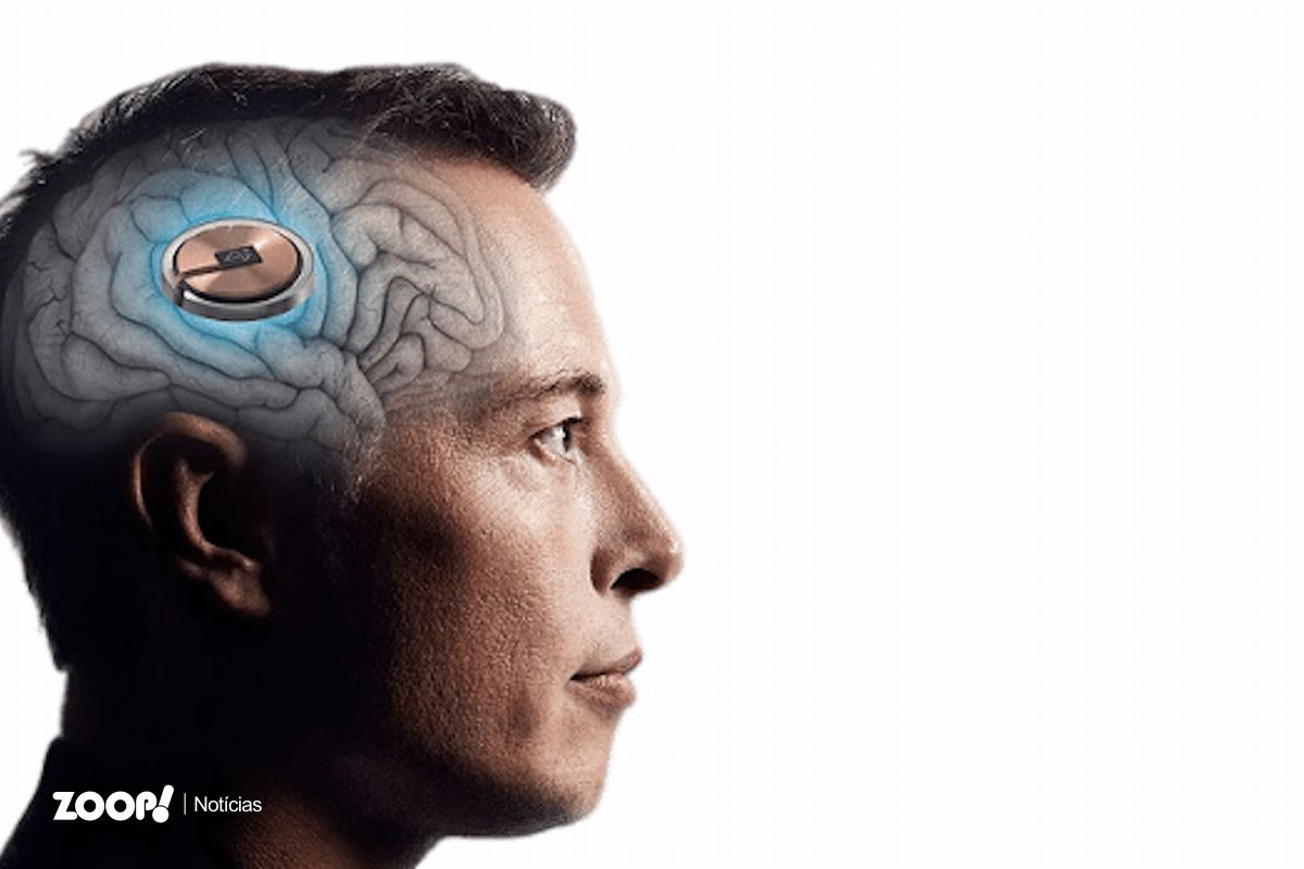 A imagem de Elen Musk de perfil mostrando um chip implantado em sua cabeça ilustra nosso artigo sobre: Neuralink de Elon Musk implanta chip cerebral no primeiro ser humano.