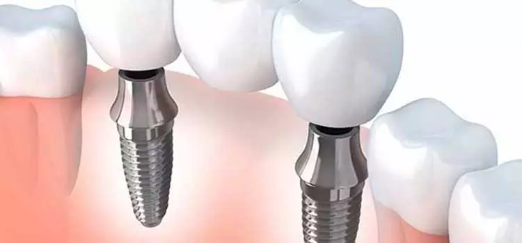 Implante de dente duplo visando a substituição de três dentes naturais.