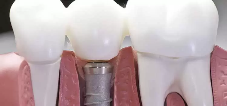 Pode ocorrer rejeição de implante dentário?