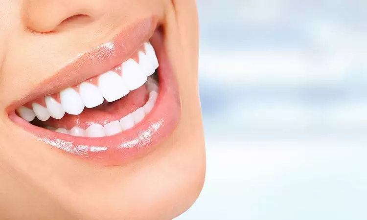 Uma mulher sorindo mostrando seus lindos dentes brancos. Quanto custa para fazer um Implante Dentário.
