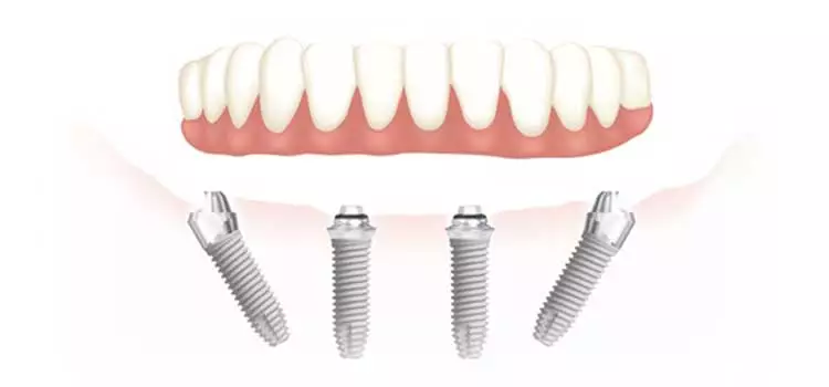 mplante dentário total: Quanto custa um implante 'ALL ON 4'.