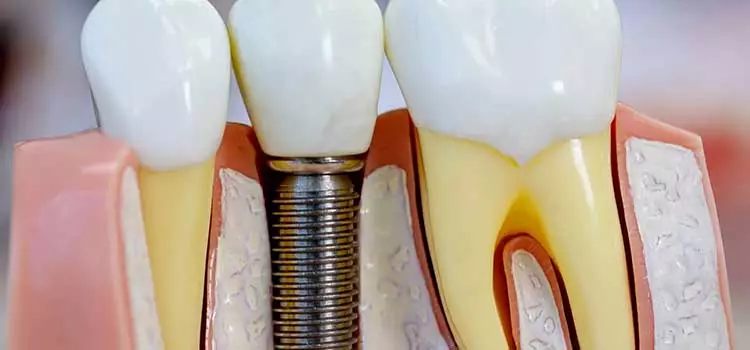 Ilustração mostrando um Implante dentário