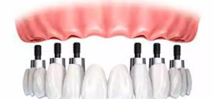 Inserção de todos os dentes, feito com 6 elementos, também chamado de allOnSix.