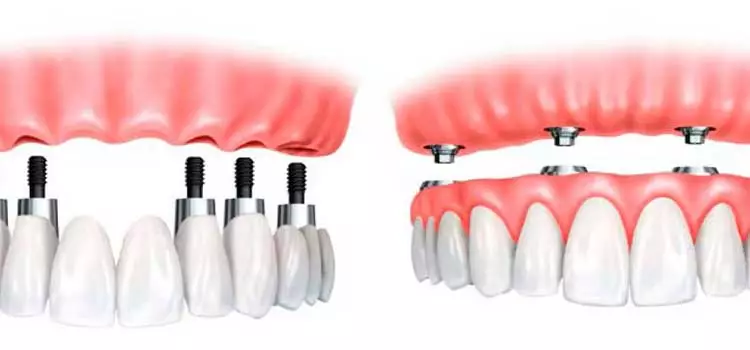 Todos os dentes, procedimento de fixação quádruplo, também chamado de allOnFour.